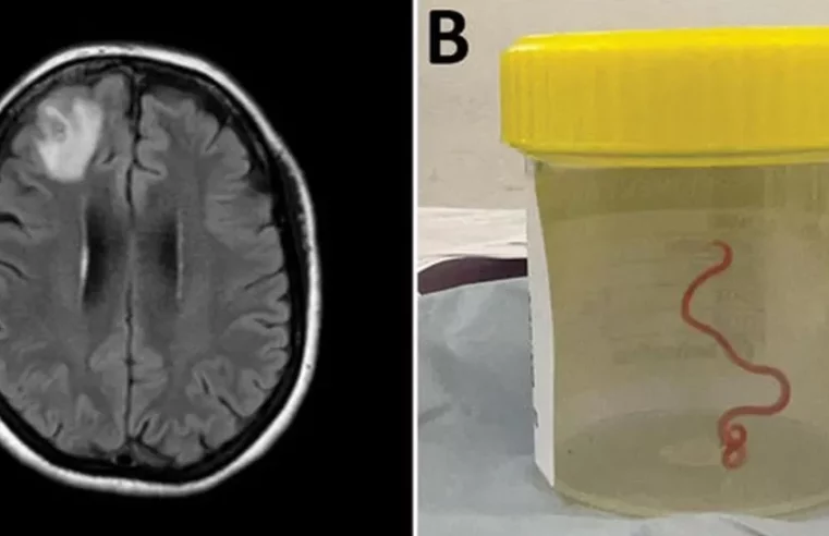 Live worm found in Australian woman’s brain in world first