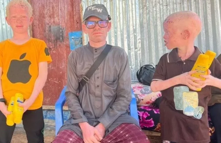 Somalis with albinism Pelted with stones and raw eggs